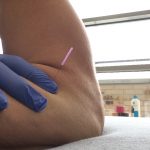 Dry Needling Fysiotherapie de Oversteek Nijmegen Noord Oosterhout pijn rugklachten
